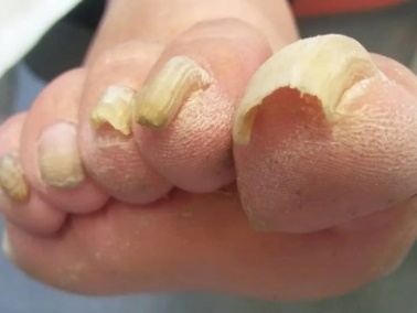 Uñas gruesas