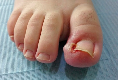 Uñero